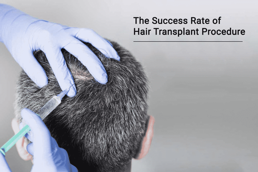 Highest Success Rate in Hair Transplant in Hyderabad, Hair color experts near me