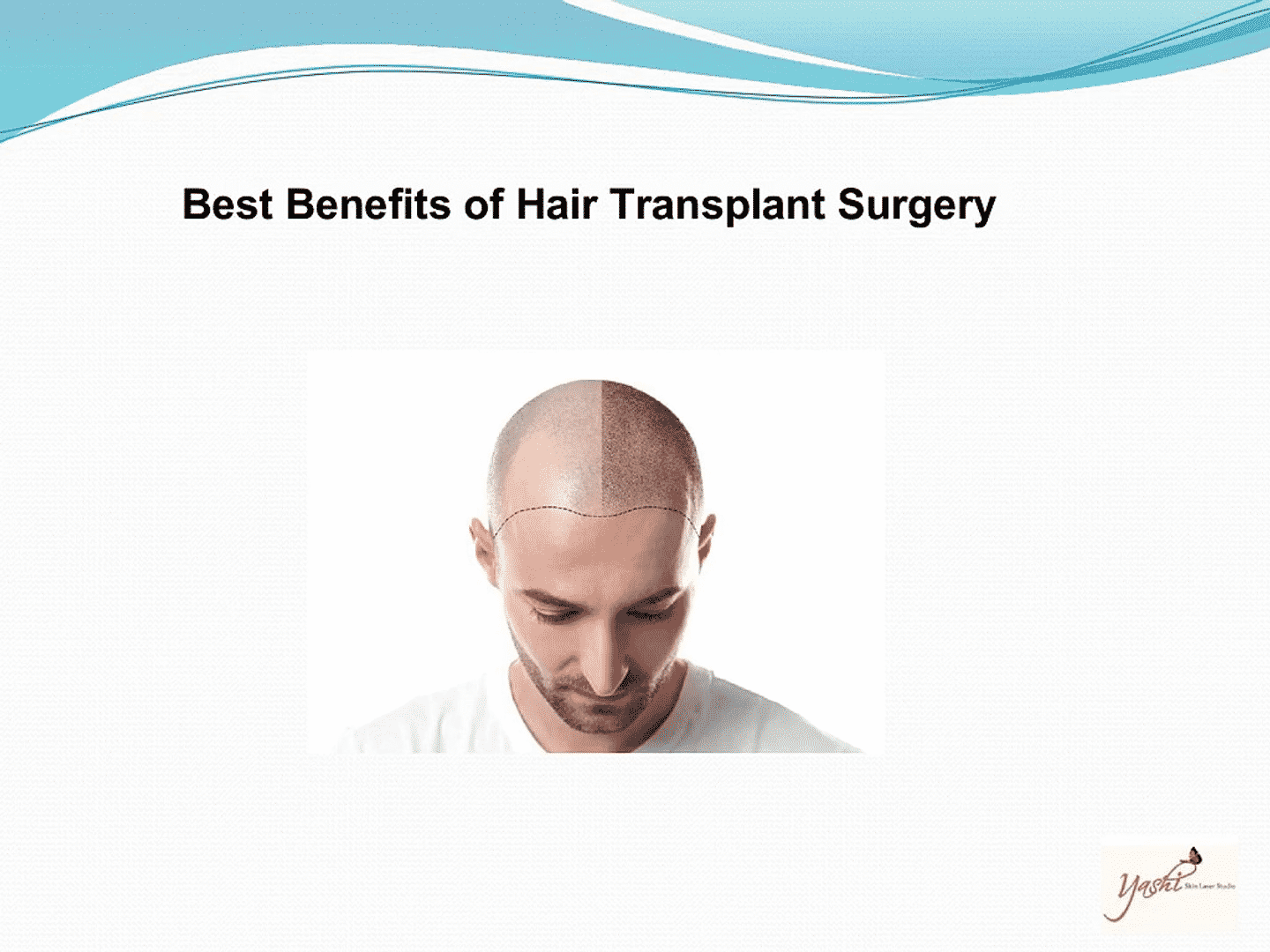 Results before after Hair transplantation surgery at Hair sure clinic, one of the best Hair care centre in Hyderabad