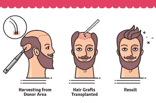 A Hair transplant can give you permanent and natural looking results by Hair sure, One of the best Hair Specialty clinic in Hyderabad