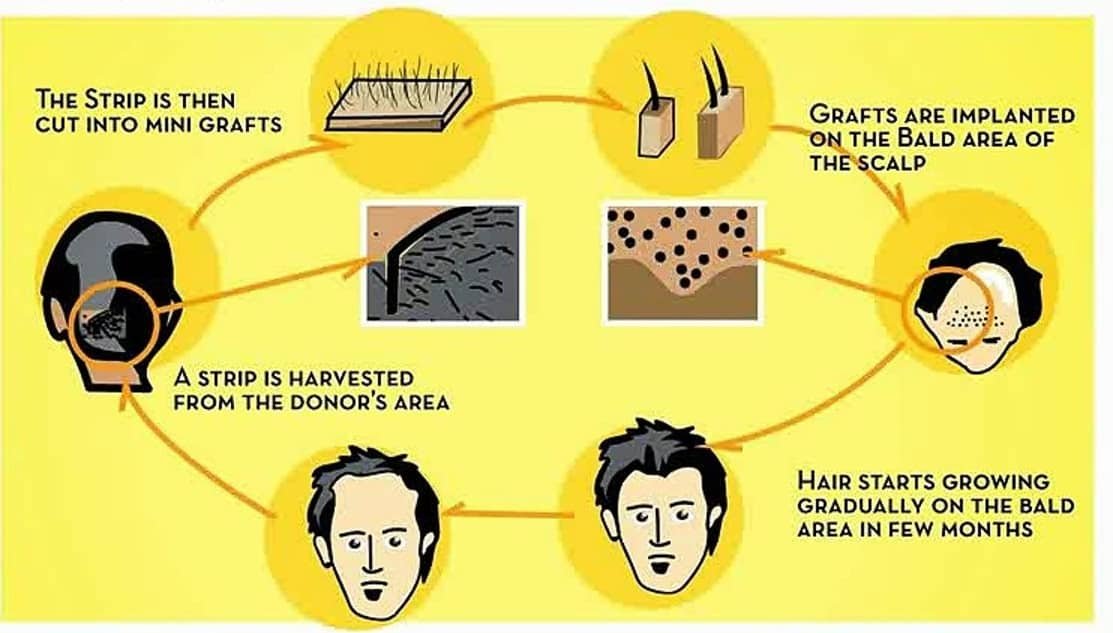 Micrograft Hair treatment in Hyderabad, Hair loss clinic near me
