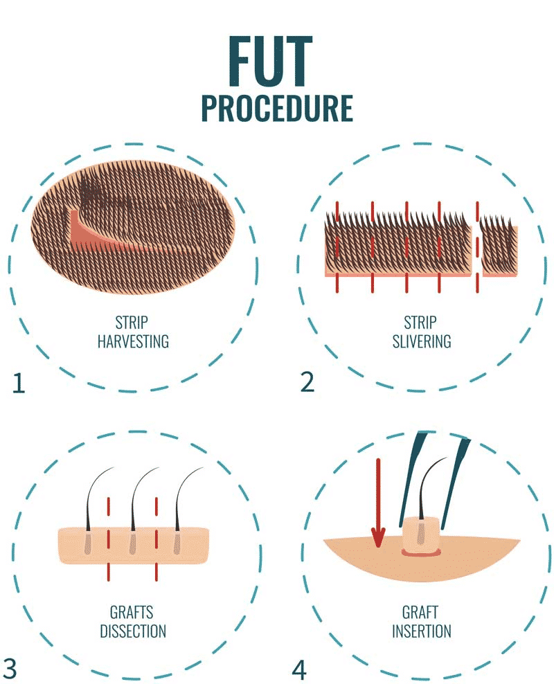 Come Hair sure to know fue hair transplant cost in Hyderabad, fue hair restoration near Uppal