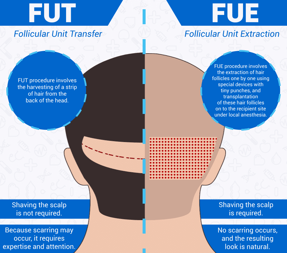 FUE Hair Transplant in Hyderabad,dermatologist near me for Hair