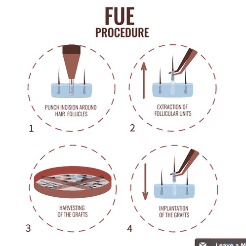 Follicular Unit Extraction treatment in Hyderabad, Hair doctor near me