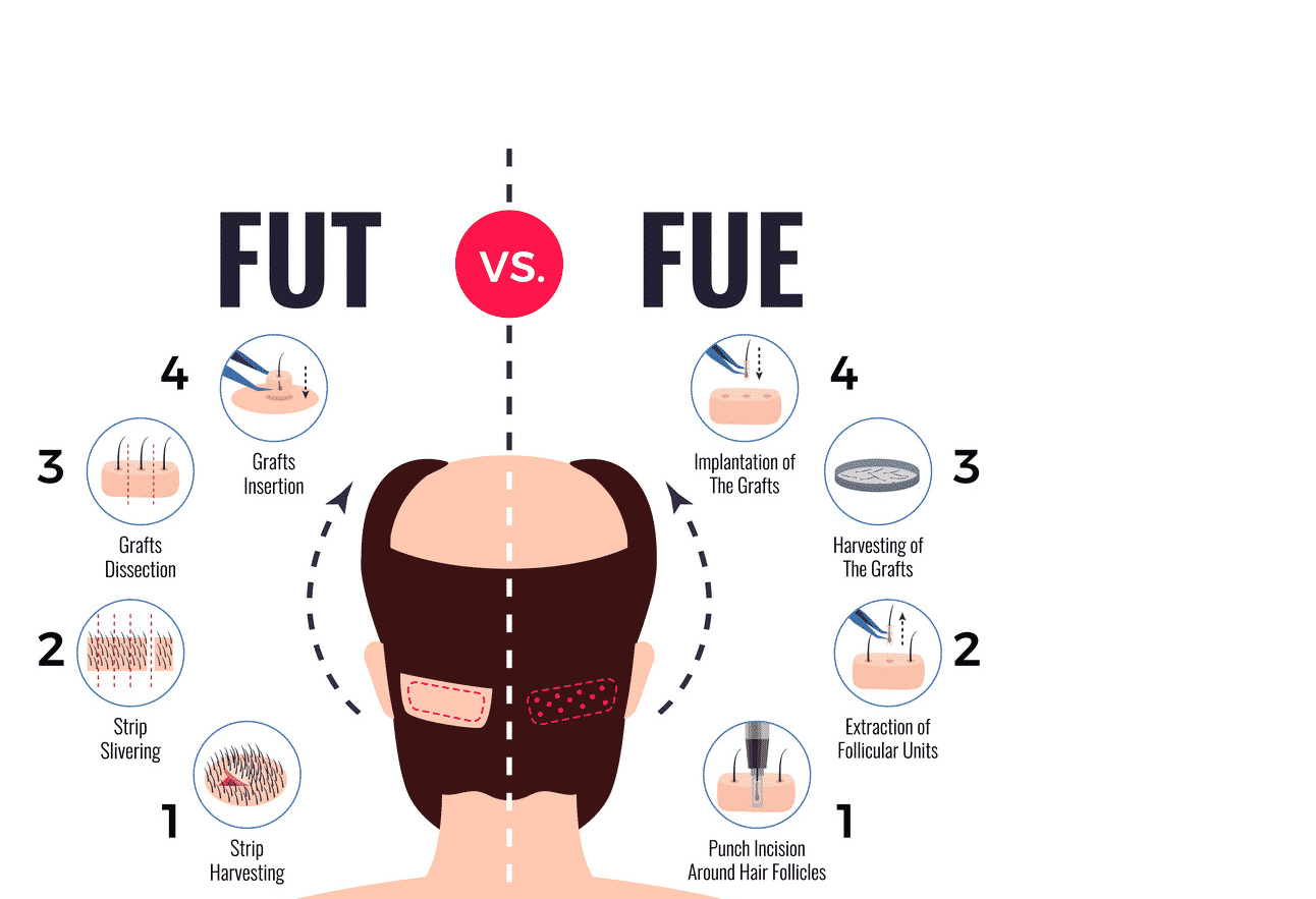 best Female Hair Transplantation in Hyderabad, Hair transplant doctors near me