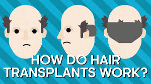 Are There Any Complications With Hair Transplantation?