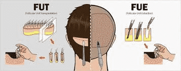 Best Treatment option for FUE and FUT in Hyderabad, scalp specialists near me