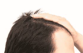 Best Hairline Reconstruction Surgery Clinic in Hyderabad,Hair treatment specialist near me
