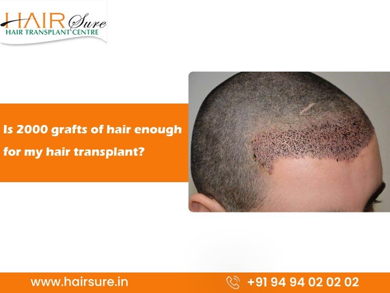 Best hair transplant clinic in Hyderabad